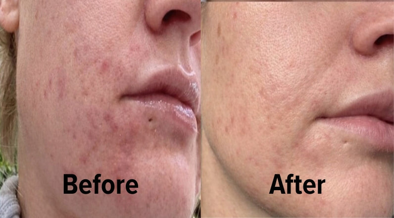 Before & After Using Beef Tallow Belly Butter on Face